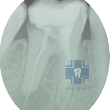 trattamenti endodontici