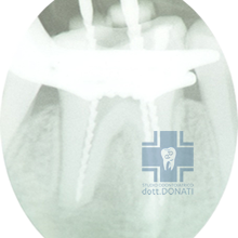 trattamenti endodontici
