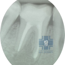 trattamenti endodontici